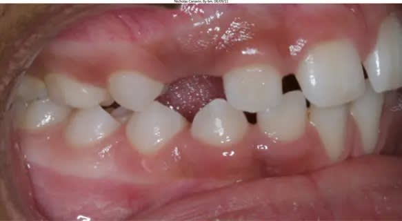 Retract cheeks with spoons, back teeth together and take photo straight on