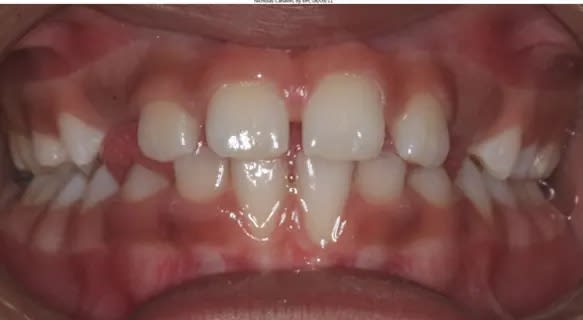 Left side teeth together with cheek retracted with spoon